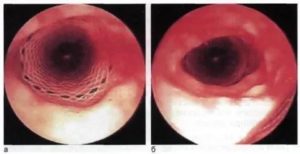 Стеноз трахеи у взрослых лечение