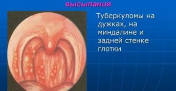 Задняя стенка горла в бугорках фото