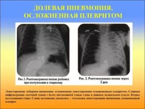 Плевральная пневмония лечение