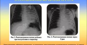 Плевральная пневмония лечение