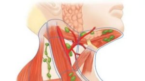 Воспаление подъязычного лимфоузла