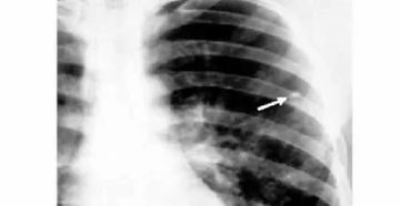 Обызвествленный очаг в легких что это