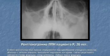 Пристеночный отек слизистой верхнечелюстной пазухи