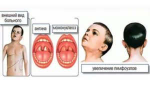 Инфекционный мононуклеоз у детей комаровский видео