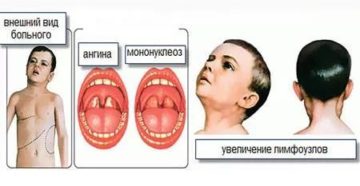 Инфекционный мононуклеоз у детей комаровский видео