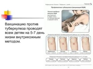 Как называется прививка от туберкулеза