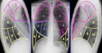 Сегменты легкого на рентгенограмме