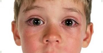 Насморк и конъюнктивит у ребенка Насморк и конъюнктивит у ребенка