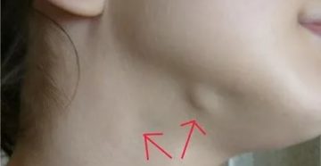 Под челюстью шарик перекатывается