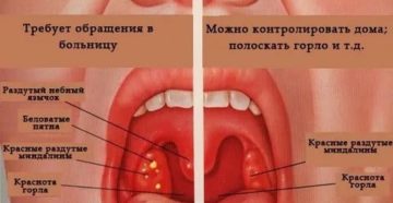 Чем снять отек горла у ребенка