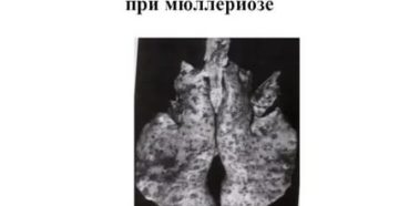 Узелковые образования в легких