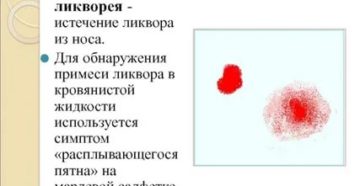 Мозговая жидкость течет из носа