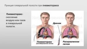 Пункция плевральной полости при пневмотораксе