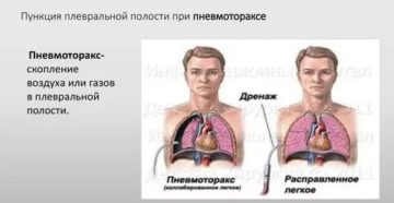 Пункция плевральной полости при пневмотораксе