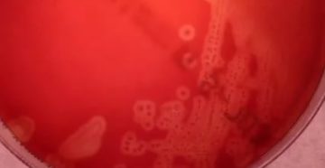 Streptococcus agalactiae у мужчин