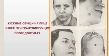 Свищ на лице