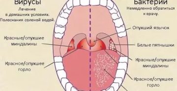 Бактериальный ларингит симптомы