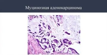 Муцинозная аденокарцинома легкого