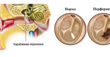 Восстановление барабанной перепонки после отита