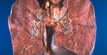 Саркоидоз легких что это такое