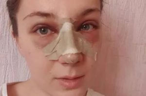 Не дышит нос после ринопластики