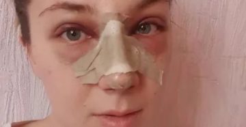 Не дышит нос после ринопластики
