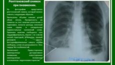 Описание пневмонии на рентгене