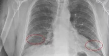 Фиброзно очаговые изменения в легких