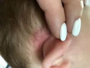 Шелушение за ушами у ребенка