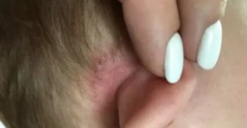 Шелушение за ушами у ребенка Шелушение за ушами у ребенка