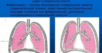 Шварта в легких причины