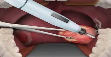 Удаление гланд лазером видео