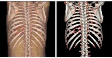 Метастазы в ребрах сколько осталось жить