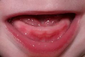 Красное горло при прорезывании зубов у детей