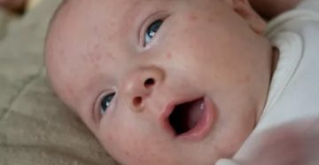Аллергия у ребёнка как лечить комаровский
