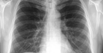 Рентгенография огк что это