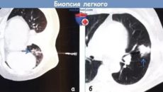 Биопсия легкого последствия