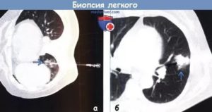 Биопсия легкого последствия