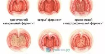Зернистость задней стенки глотки