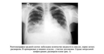 Синусы легких на рентгенограмме