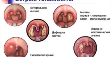 Ангина лакунарная и фолликулярная отличия