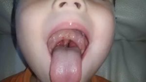 Сыпь на горле у ребенка фото