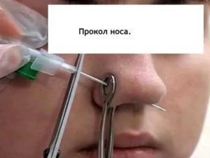 Какой нужен катетер для прокола носа