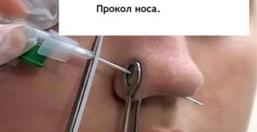 Какой нужен катетер для прокола носа