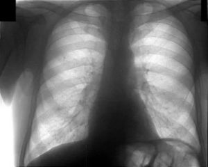 Видно ли на флюорографии пневмонию