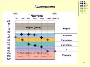 Расшифровка аудиограммы слуха