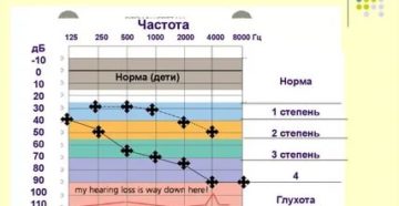 Расшифровка аудиограммы слуха