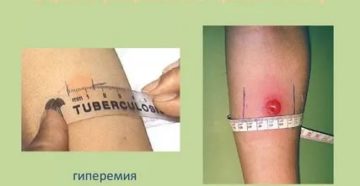 Как по манту определить туберкулез