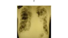 Поддувание легких при туберкулезе последствия