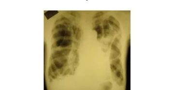 Поддувание легких при туберкулезе последствия